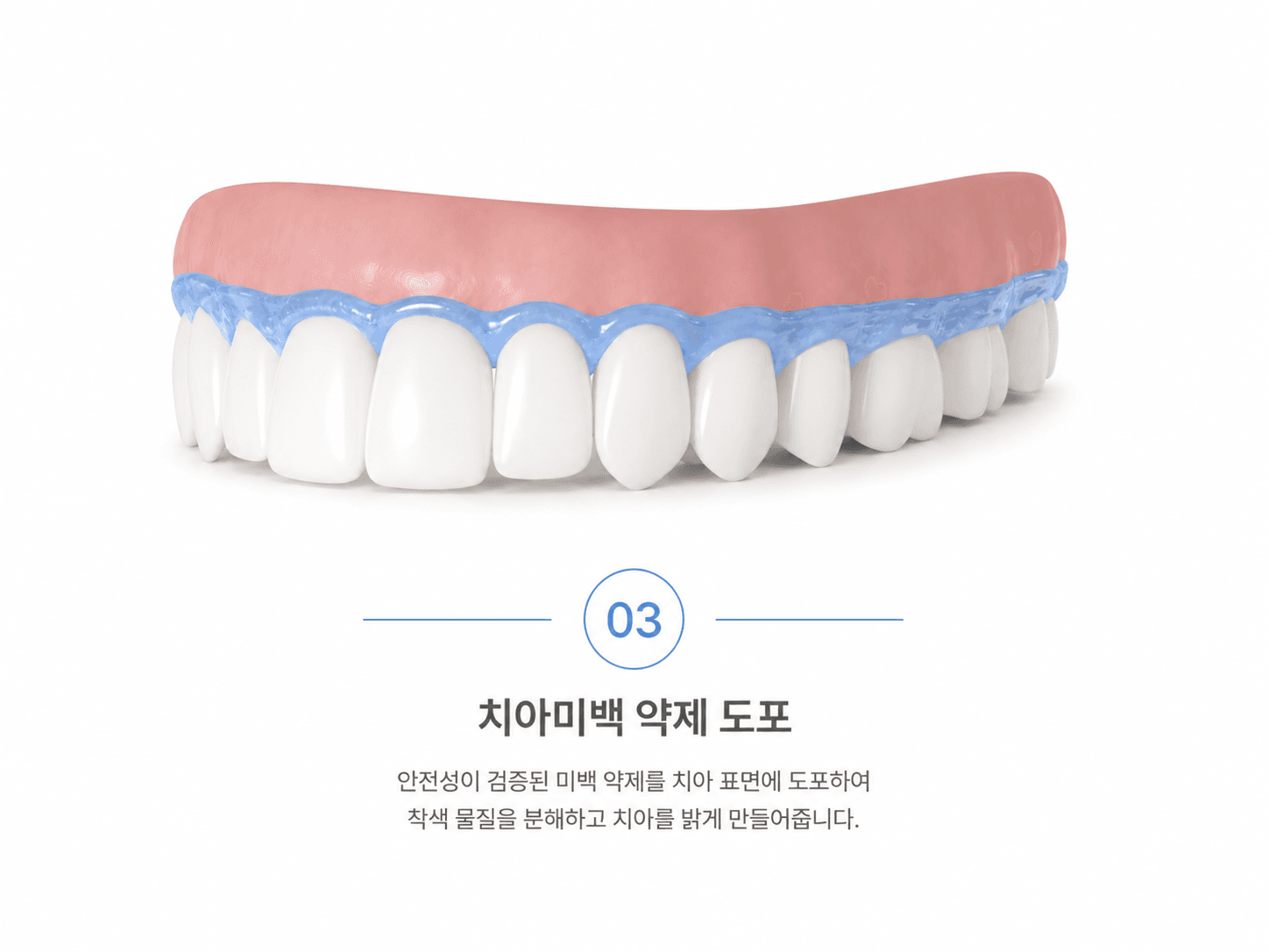 치아미백 약재 도포